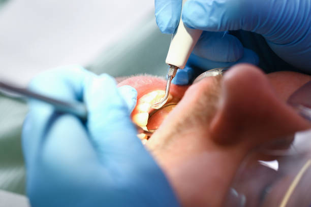 Best Emergency Tooth Extraction in Kingstown, MD